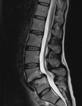 Het ‘zware’ leven van de lumbale disci intervertebrales (BD)
