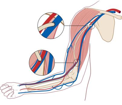 Vaattoegang voor hemodialyse