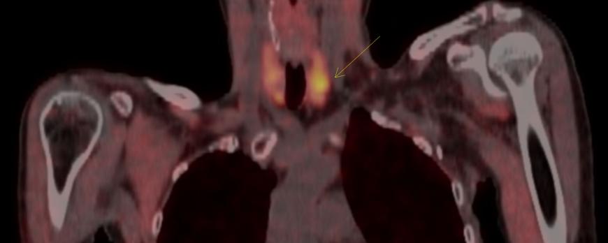 Hyperfunctionele bijschildklieren bij hyperparathyreoïdie