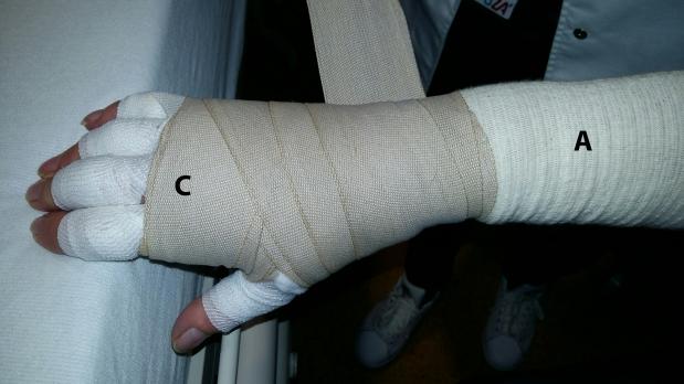 Wat is de meerwaarde van manuele lymfedrainage binnen de behandeling van chronisch borstkanker-gerelateerd lymfoedeem?