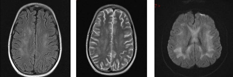 Toxicologie en de hersenen: acute toxische leuko-encefalopathie in beeld