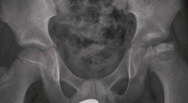 Pijn in de heup bij kinderen