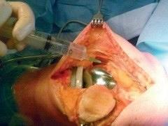 Fast-track orthopedie