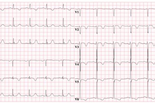 Cardiale complicaties bij subarachnoïdale bloedingen