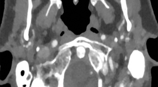 Acute en subacute binoculaire visuele stoornissen 