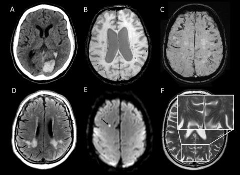 Cerebrale amyloïdangiopathie: een uitbreidend klinisch spectrum