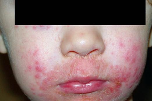 De bijwerkingen van dermatocorticosteroïden