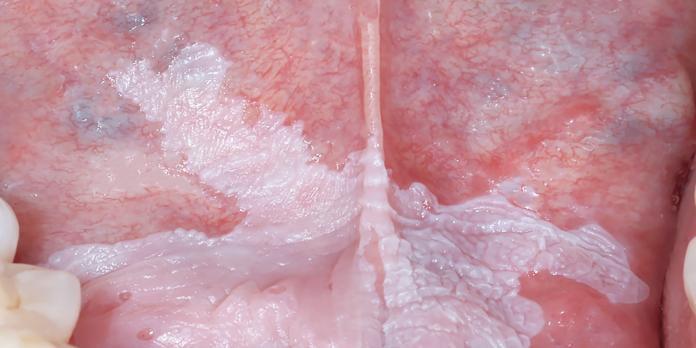 Leukoplakie en daarop lijkende afwijkingen