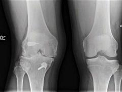 Beschermt een voorstekruisbandreconstructie tegen artrose van de knie?