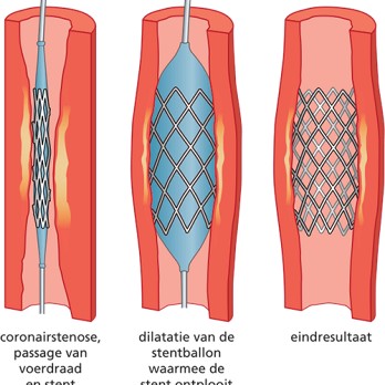 Myocardiale revascularisatie 