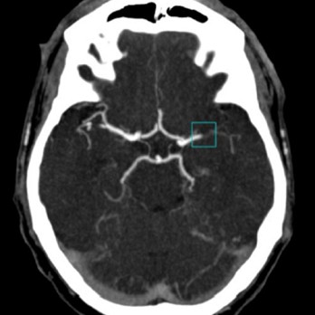 Artificiële intelligentie in de neuroradiologie 