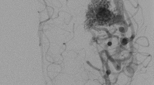 Cerebrale arterioveneuze malformaties: diagnose en beleid