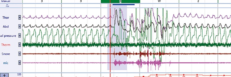 Polysomnografieonderzoek beoordelen 