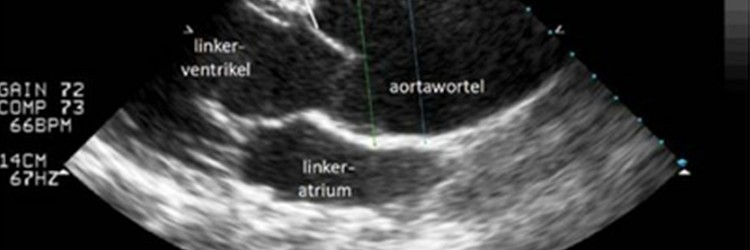 Erfelijke thoracale aortapathologie 