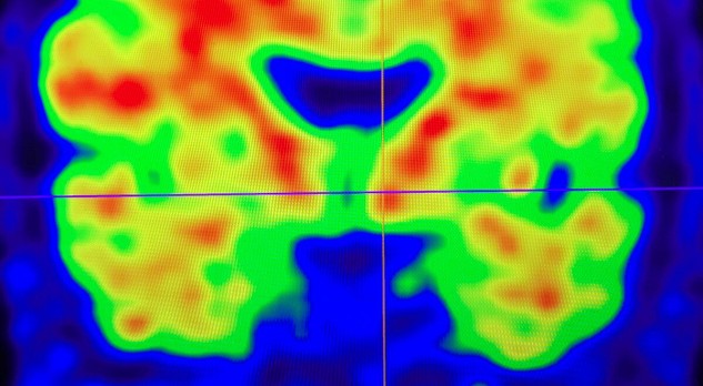 De ziekte van Alzheimer, achtergrond en diagnostiek 