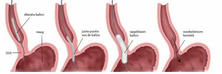 Achalasie en perorale endoscopische myotomie (POEM)