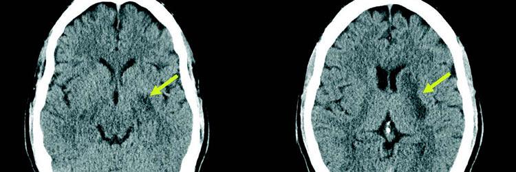 Looptraining na een CVA in de rechterhemisfeer