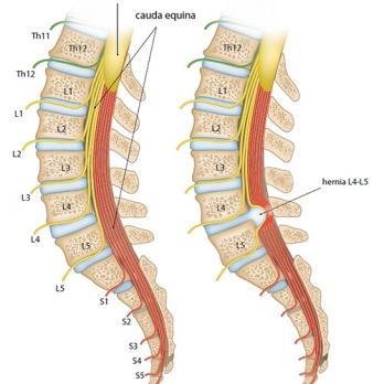 Het lumbosacraal radiculair syndroom vanuit neurologisch perspectief (VI)
