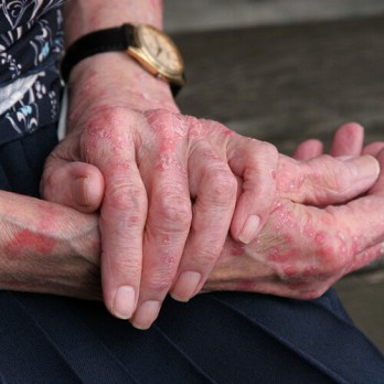 Allergie voor methyl(chloor) isothiazolinonen, in de praktijk en op de werkvloer 