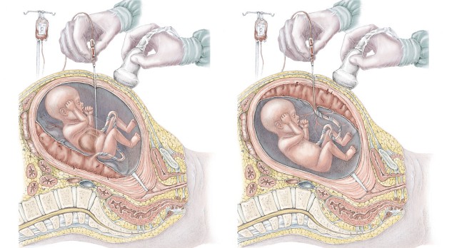 Hemolytische ziekte van de foetus en pasgeborene 