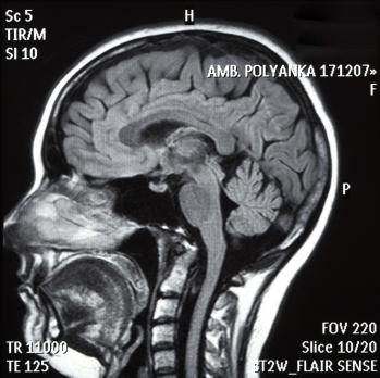 Pathofysiologie en behandeling van posttraumatisch hersenoedeem