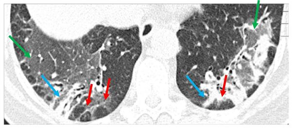Medicatie-geïnduceerde longziekten