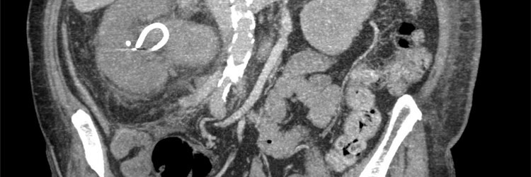 Niervenentrombose als complicatie van membraneuze nefropathie 