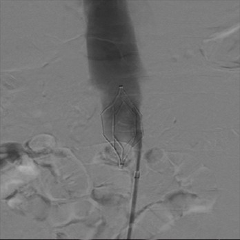 De vena cava filter, indicaties en complicaties