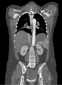 Aortadissectie – een voorstel voor diagnostische work-up