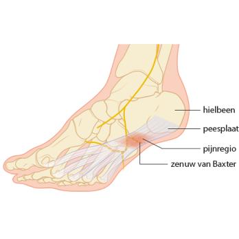 Fasciitis plantaris als beroepsziekte 