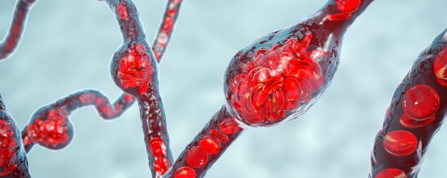 Transkatheter aortaklepimplantatie (TAVI)