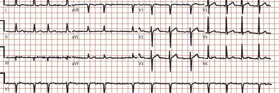 Atriumfibrilleren in de anesthesiologische praktijk