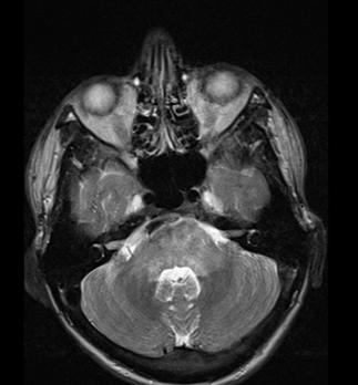 Posterior reversible encephalopathy syndrome (pres) 