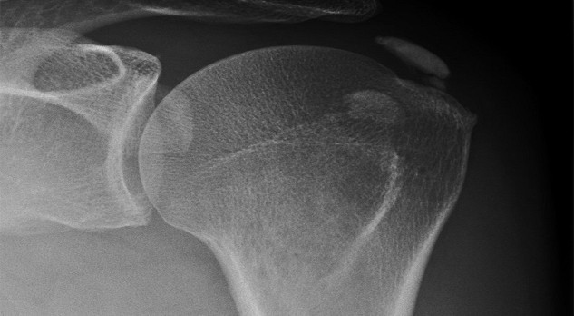 Calcificerende tendinopathie van de rotator cuff