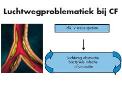 Cystic Fibrosis