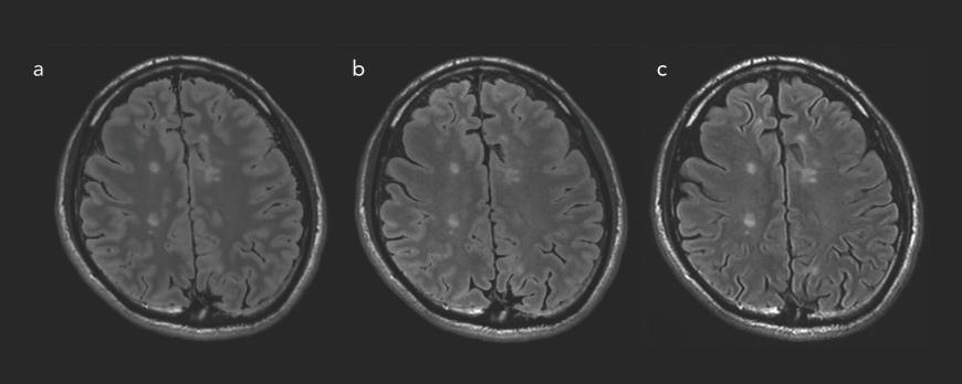 Kunstmatige intelligentie in de radiologie voor neuro-oncologie