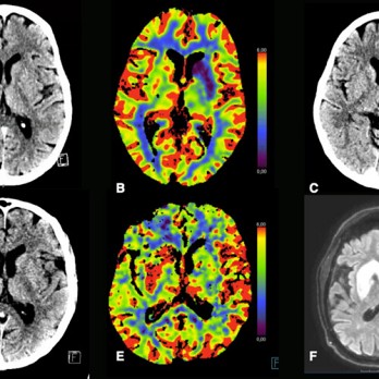 Intraveneuze en endovasculaire behandeling van het acute herseninfarct