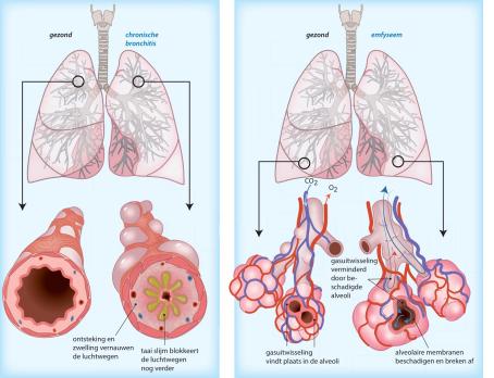 Fysiotherapie bij chronisch obstructief longlijden (VI)