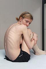 Refeedingbehandeling bij anorexia nervosa