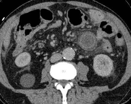 Quiz: pijn in de buik links met koorts