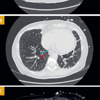 Rechterventrikelfalen door pulmonale hypertensie op de IC 