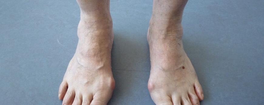 Multidisciplinaire diagnostiek en behandeling van de reumatische voet (BG)