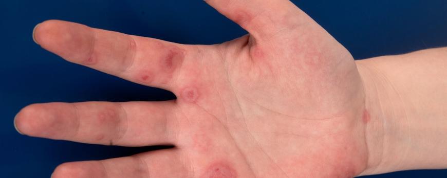 Mucocutane afwijkingen bij kinderen