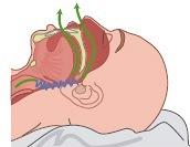 Obstructief slaapapneusyndroom (OSAS): definitie, diagnostiek en behandeling