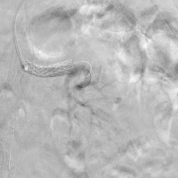 Percutane transluminale angioplastiek bij atherosclerotische arteriarenalisstenose