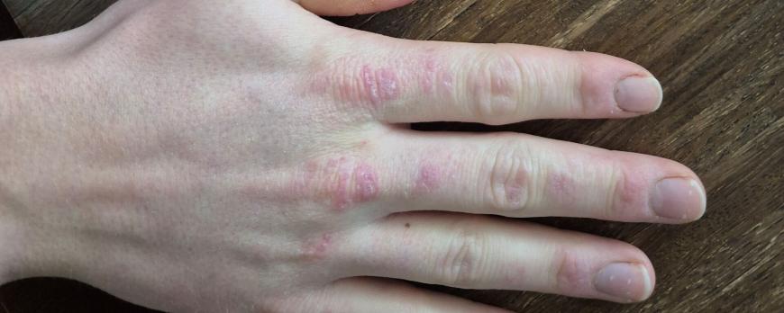 Creatinekinase bij de diagnose juveniele dermatomyositis