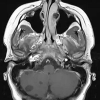 Neurocysticercose in Nederland? 