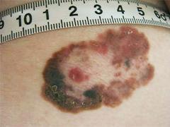 Een plekje op de rug