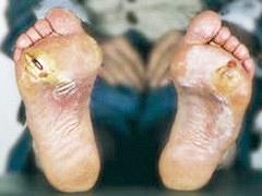 De invloed van stofwisselingsstoornissen op bindweefsel