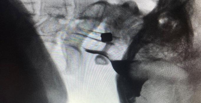 Invasieve pijnbehandeling bij neuropathische en oncologische pijn